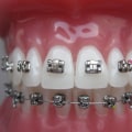What are orthodontic fixed appliances?