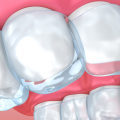 Orthodontic Treatment With Invisalign: What You Need To Know In Austin
