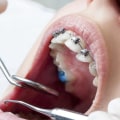 The Significance Of Visiting A Skilled Orthodontist For Orthodontic Treatment In Huntington