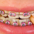 What is considered an orthodontic appliance?