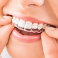 The Best Orthodontic Practices In Canberra For Adult Braces