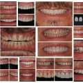 Transform Your Smile: How Veneer Dentistry And Orthodontics Can Enhance Your Oral Aesthetics In Conroe