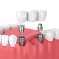 A Winning Combination: Orthodontics And Dental Implants In Georgetown For Ultimate Oral Health