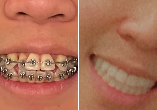 Dental Crowns And Orthodontics In Ashburn, VA: A Winning Combination For A Perfect Smile